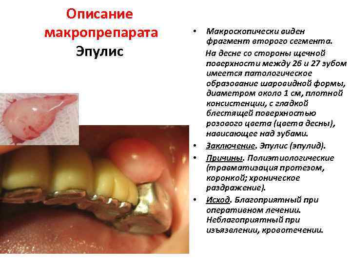 Описание макропрепарата Эпулис Макроскопически виден фрагмент второго сегмента. На десне со стороны щечной поверхности