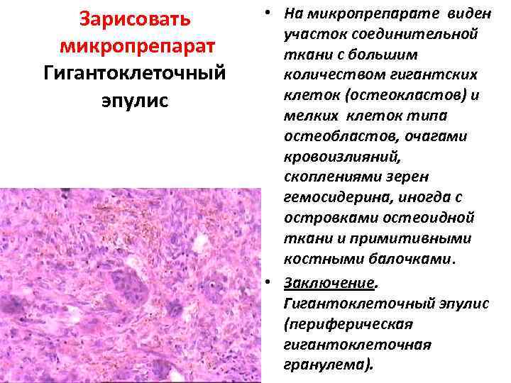 Зарисовать микропрепарат Гигантоклеточный эпулис • На микропрепарате виден участок соединительной ткани с большим количеством