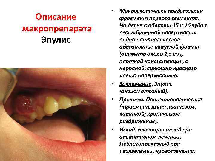 Описание макропрепарата Эпулис • Макроскопически представлен фрагмент первого сегмента. На десне в области 15