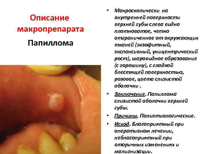 Описание макропрепарата Папиллома • Макроскопически на внутренней поверхности верхней губы слева видно плотноватое, четко