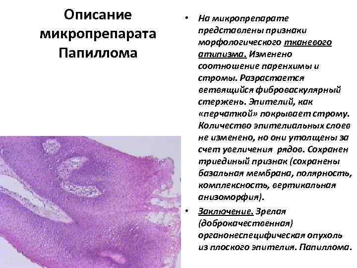 Описание микропрепарата Папиллома • На микропрепарате представлены признаки морфологического тканевого атипизма. Изменено соотношение паренхимы