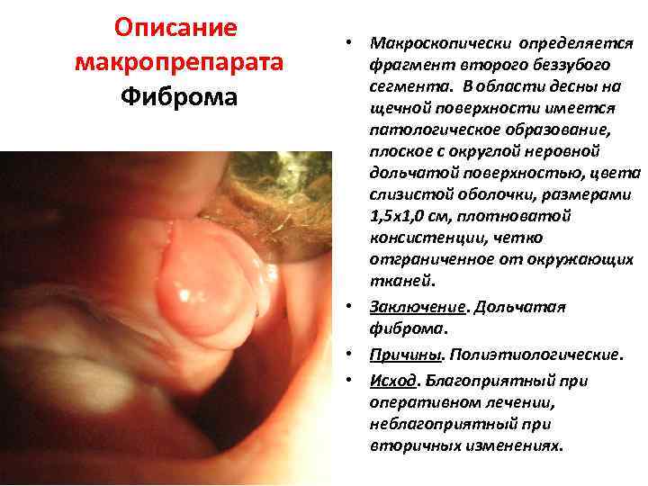 Описание макропрепарата Фиброма • Макроскопически определяется фрагмент второго беззубого сегмента. В области десны на