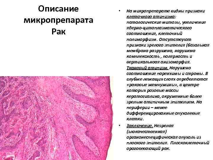 Описание микропрепарата Рак • • На микропрепарате видны признаки клеточного атипизма: патологические митозы, увеличение