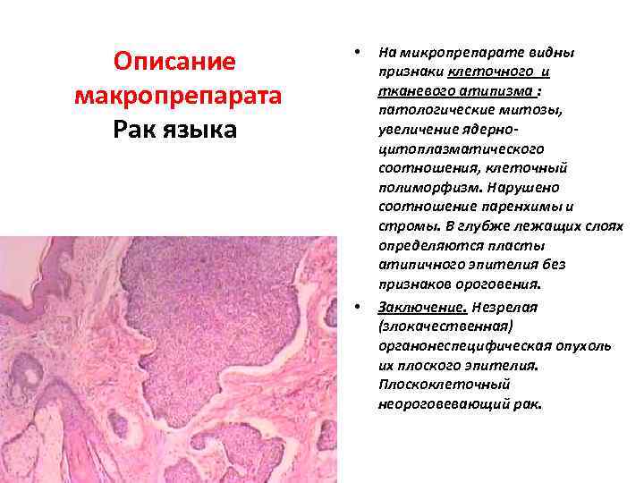 Описание макропрепарата Рак языка • • На микропрепарате видны признаки клеточного и тканевого атипизма