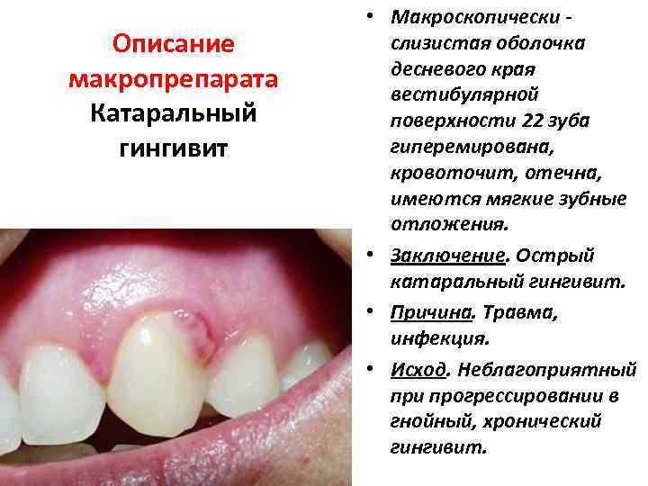 Описание макропрепарата Катаральный гингивит • Макроскопически слизистая оболочка десневого края вестибулярной поверхности 22 зуба