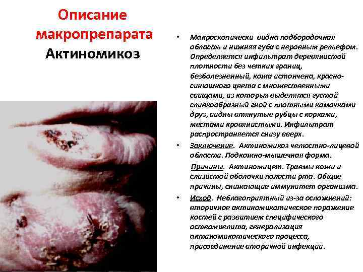 Описание макропрепарата Актиномикоз • • • Макроскопически видна подбородочная область и нижняя губа с