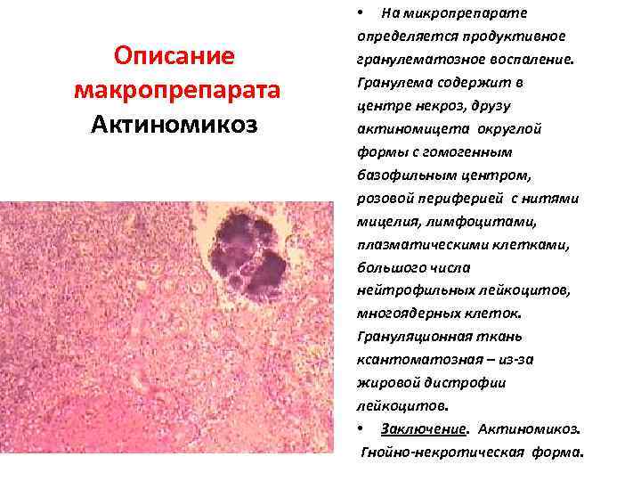 Описание макропрепарата Актиномикоз • На микропрепарате определяется продуктивное гранулематозное воспаление. Гранулема содержит в центре