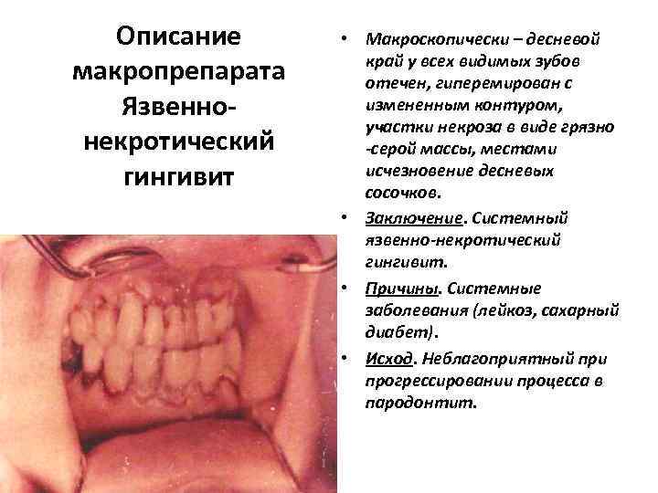 Описание макропрепарата Язвеннонекротический гингивит • Макроскопически – десневой край у всех видимых зубов отечен,