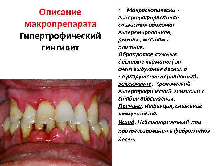 Описание макропрепарата Гипертрофический гингивит • Макроскопически гипертрофированная слизистая оболочка гиперемированная, рыхлая , местами плотная.