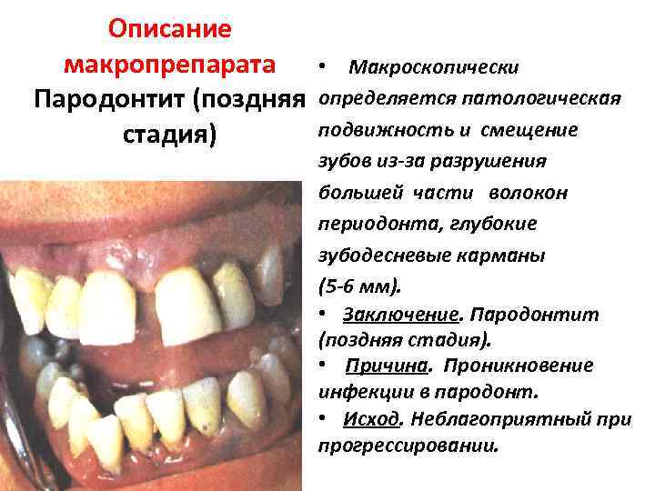 Описание макропрепарата Пародонтит (поздняя стадия) • Макроскопически определяется патологическая подвижность и смещение зубов из-за