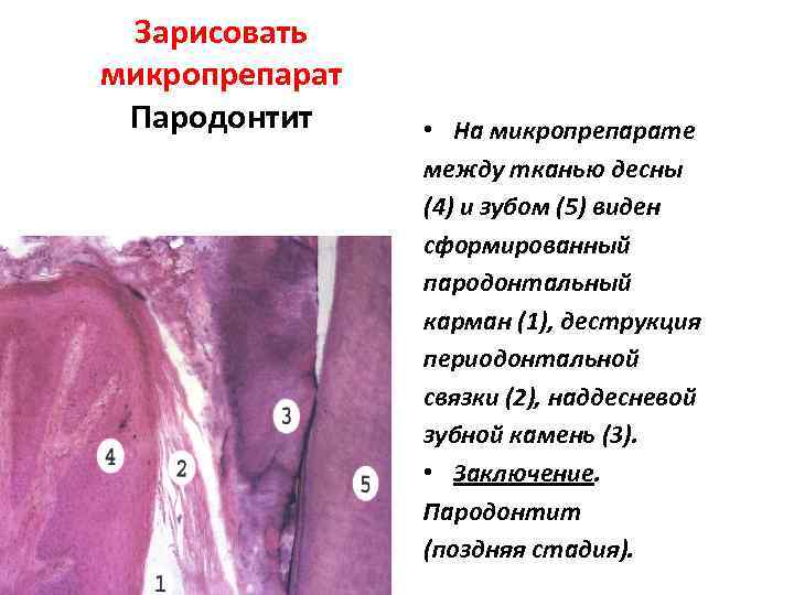 Зарисовать микропрепарат Пародонтит • На микропрепарате между тканью десны (4) и зубом (5) виден