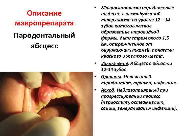 Описание макропрепарата Пародонтальный абсцесс • Макроскопически определяется на десне с вестибулярной поверхности на уровне