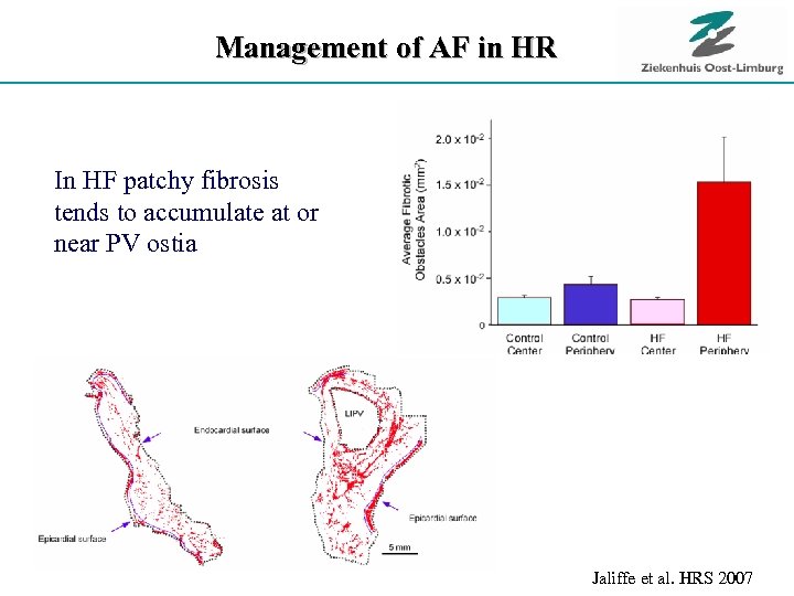 Management of AF in HR In HF patchy fibrosis tends to accumulate at or