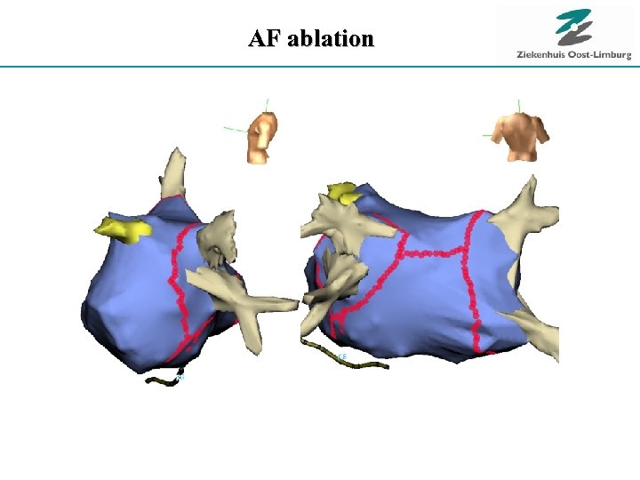 AF ablation 