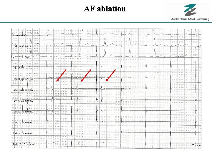 AF ablation RSPV 