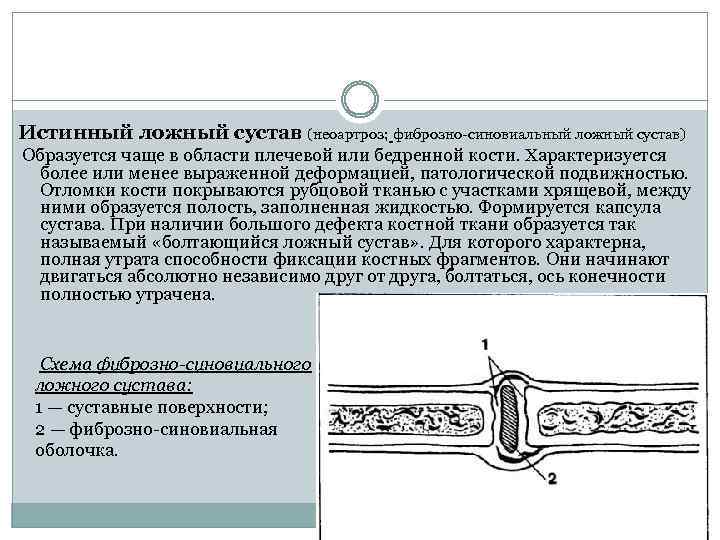 Истинный ложный сустав (неоартроз; фиброзно-синовиальный ложный сустав) Образуется чаще в области плечевой или бедренной