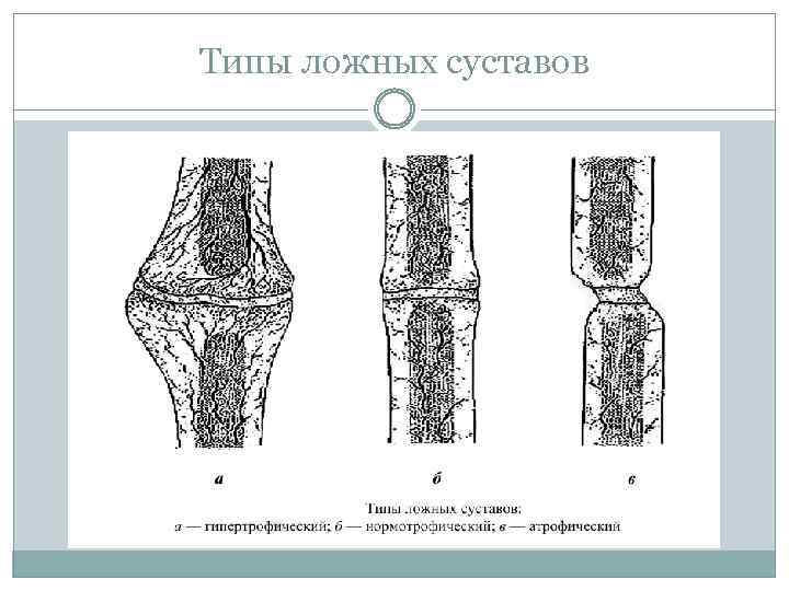 Типы ложных суставов 