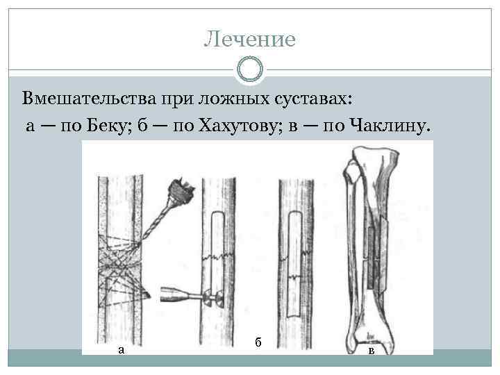 Лечение Вмешательства при ложных суставах: а — по Беку; б — по Хахутову; в