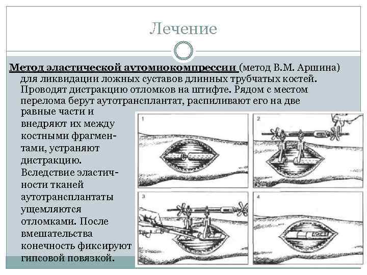 Лечение Метод эластической аутомиокомпрессии (метод В. М. Аршина) для ликвидации ложных суставов длинных трубчатых