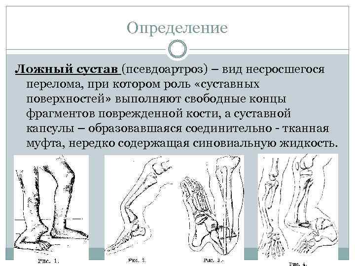 Определение Ложный сустав (псевдоартроз) – вид несросшегося перелома, при котором роль «суставных поверхностей» выполняют