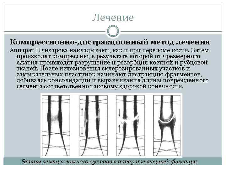 Лечение Компрессионно-дистракционный метод лечения Аппарат Илизарова накладывают, как и при переломе кости. Затем производят