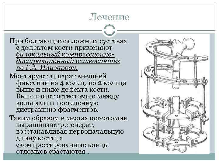 Лечение При болтающихся ложных суставах с дефектом кости применяют билокальный компрессионнодистракционный остеосинтез по Г.