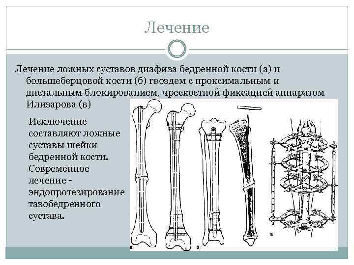 Лечение ложных суставов диафиза бедренной кости (а) и большеберцовой кости (б) гвоздем с проксимальным