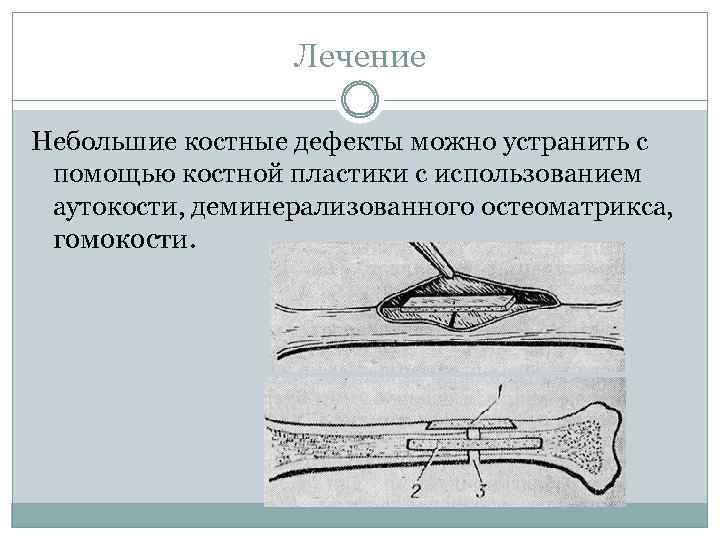 Лечение Небольшие костные дефекты можно устранить с помощью костной пластики с использованием аутокости, деминерализованного