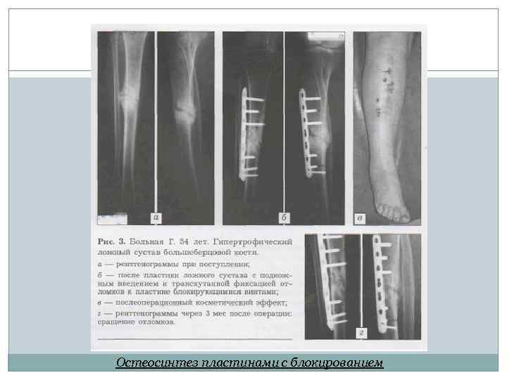 Остеосинтез пластинами с блокированием 