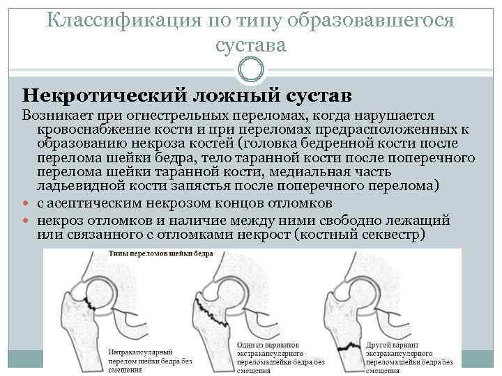 Классификация по типу образовавшегося сустава Некротический ложный сустав Возникает при огнестрельных переломах, когда нарушается