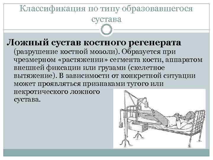 Классификация по типу образовавшегося сустава Ложный сустав костного регенерата (разрушение костной мозоли). Образуется при