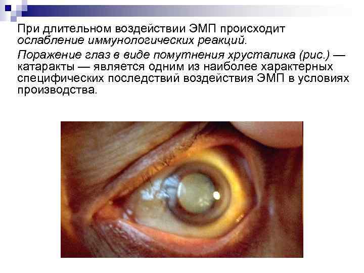 При длительном воздействии ЭМП происходит ослабление иммунологических реакций. Поражение глаз в виде помутнения хрусталика