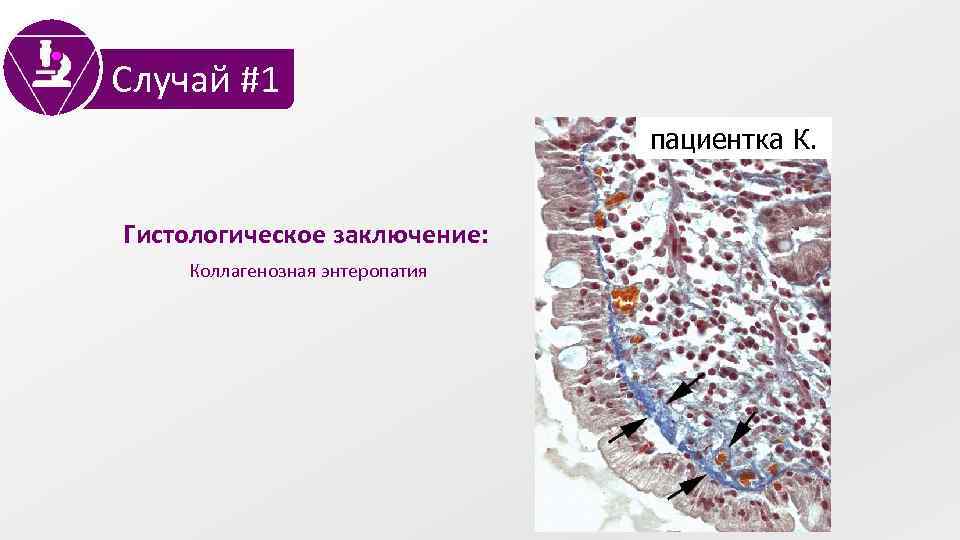 1 случай. Гиперрегенераторная атрофия гистология. Коллагенозная нефропатия. Коллагенозный момиоси. Коллагенозный перикардит.