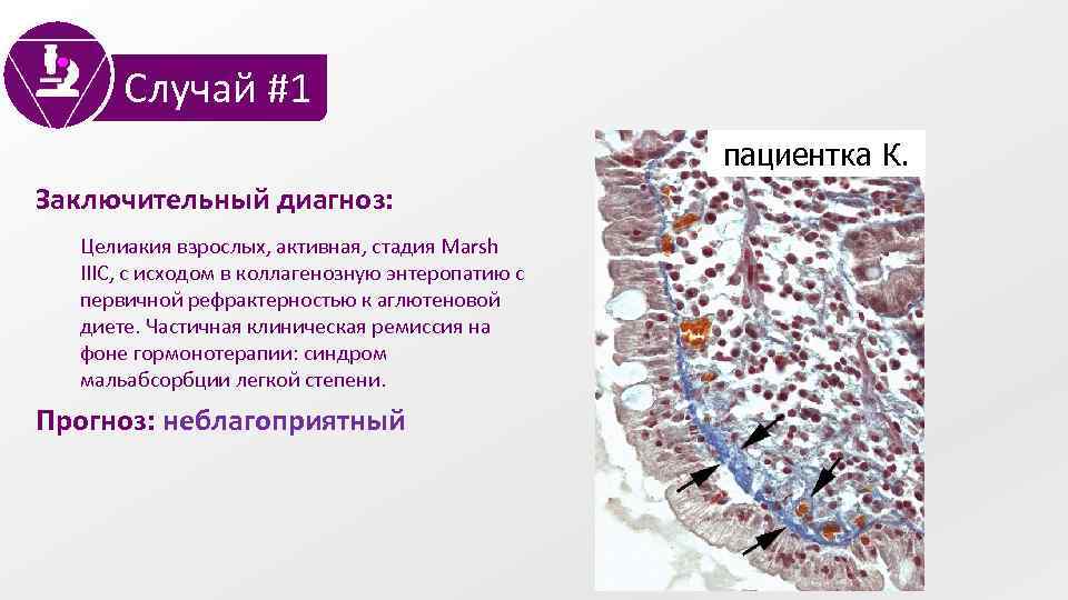 Случай #1 пациентка К. Заключительный диагноз: Целиакия взрослых, активная, стадия Marsh IIIC, с исходом