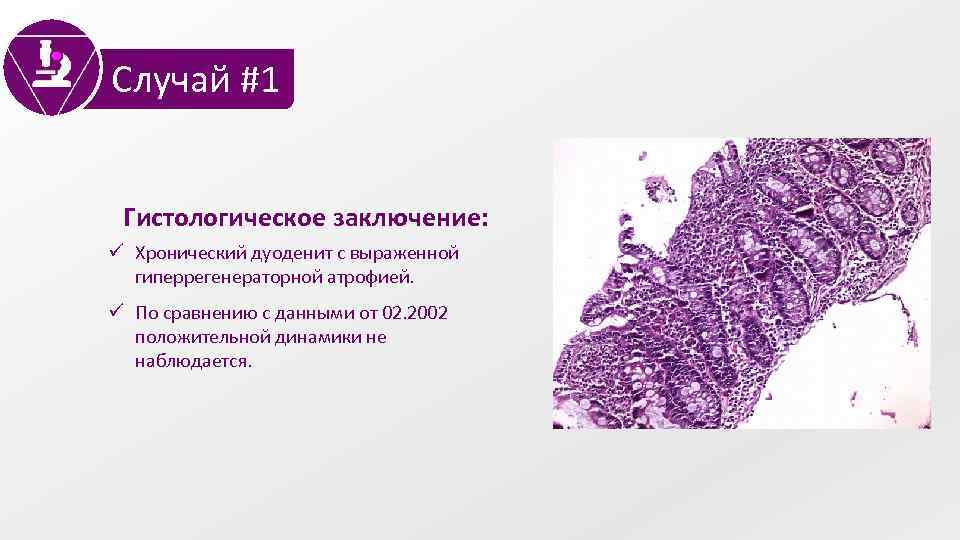 Случай #1 Гистологическое заключение: ü Хронический дуоденит с выраженной гиперрегенераторной атрофией. ü По сравнению
