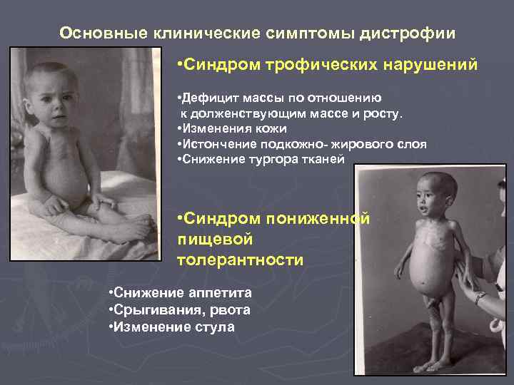 Основные клинические симптомы дистрофии • Синдром трофических нарушений • Дефицит массы по отношению к