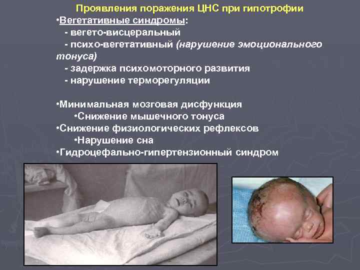 Проявления поражения ЦНС при гипотрофии • Вегетативные синдромы: - вегето-висцеральный - психо-вегетативный (нарушение эмоционального