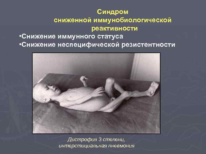 Синдром сниженной иммунобиологической реактивности • Снижение иммунного статуса • Снижение неспецифической резистентности Дистрофия 3