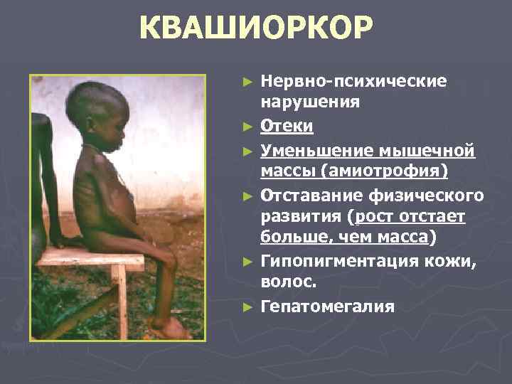 КВАШИОРКОР Нервно-психические нарушения ► Отеки ► Уменьшение мышечной массы (амиотрофия) ► Отставание физического развития