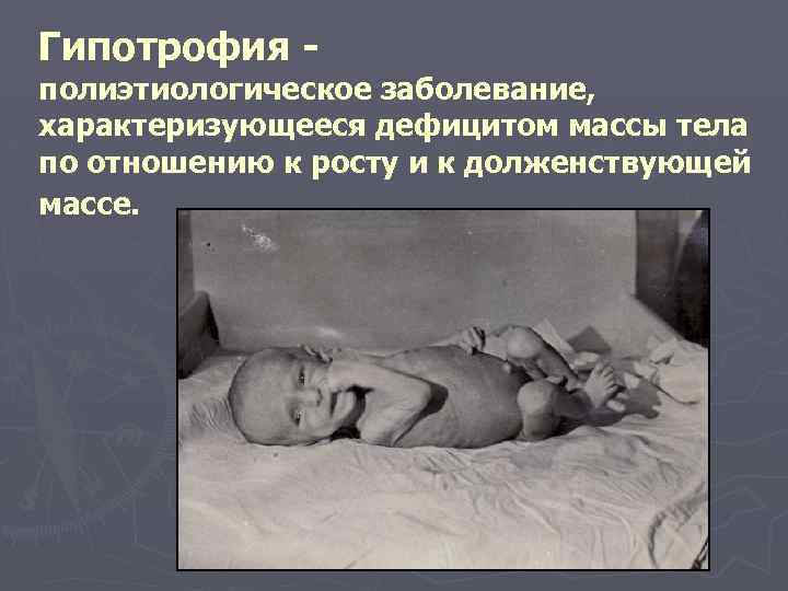 Гипотрофия - полиэтиологическое заболевание, характеризующееся дефицитом массы тела по отношению к росту и к