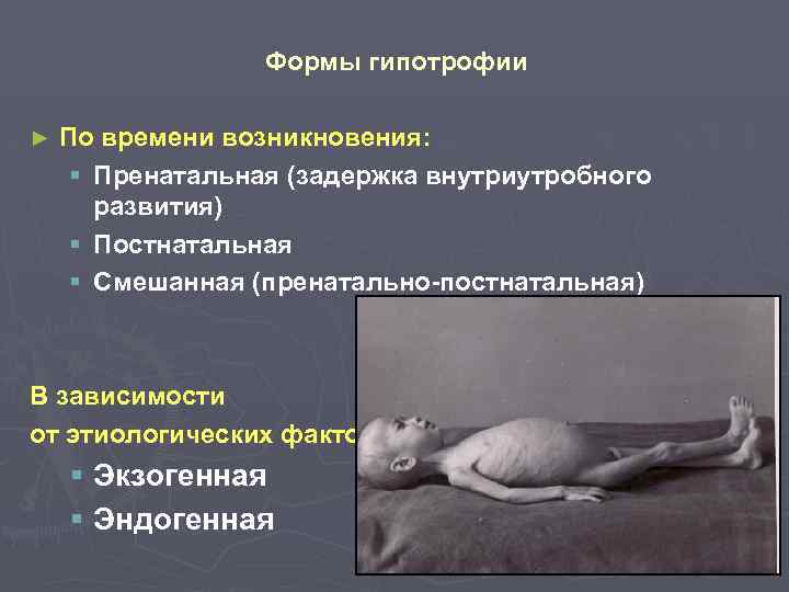 Формы гипотрофии ► По времени возникновения: § Пренатальная (задержка внутриутробного развития) § Постнатальная §