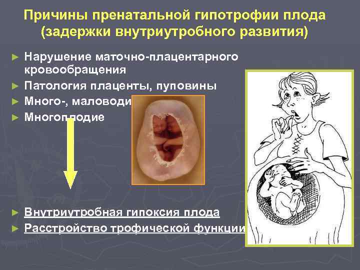 Причины пренатальной гипотрофии плода (задержки внутриутробного развития) Нарушение маточно-плацентарного кровообращения ► Патология плаценты, пуповины