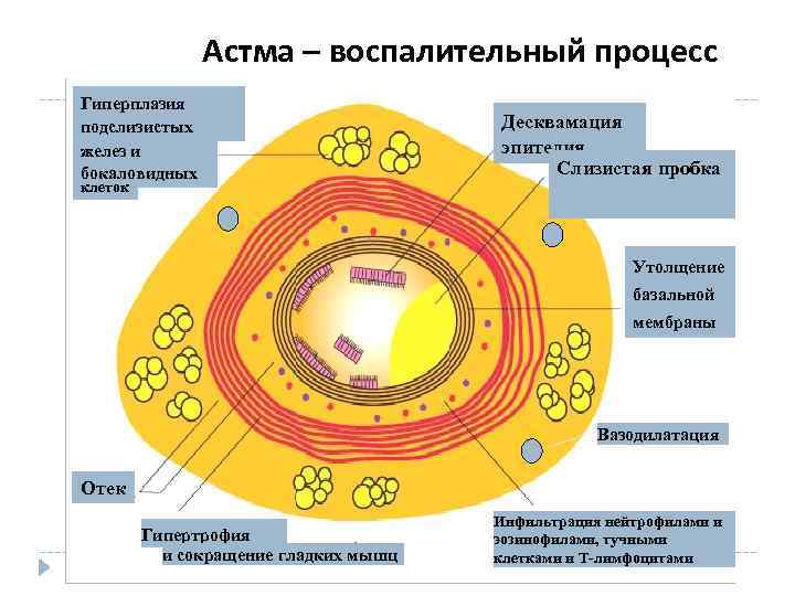 Астма – воспалительный процесс Гиперплазия подслизистых желез и бокаловидных Десквамация эпителия Слизистая пробка клеток