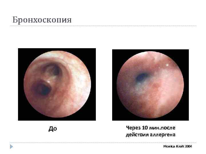 Бронхоскопия До Через 10 мин. после действия аллергена Monica Kraft 2004 