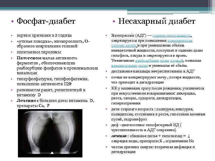 • Фосфат-диабет • первые признаки в 2 годика • «утиная походка» , низкорослость,