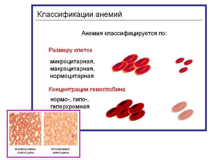 Классификация анемий. Типы анемий и их характеристика. Классификация анемий схема. Классификация анемий по размеру эритроцитов.