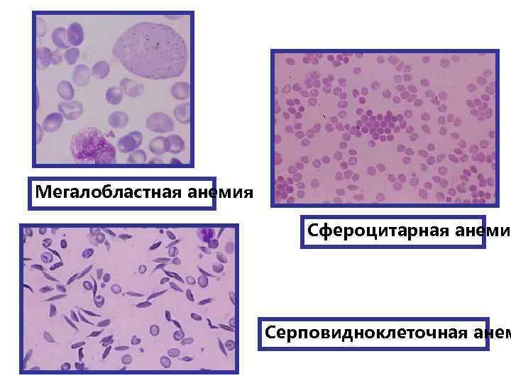 Мегалобластная анемия клиническая картина