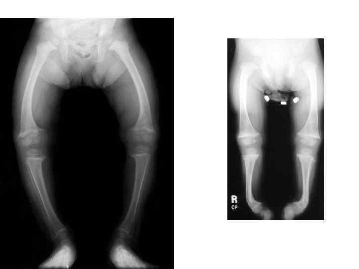Эпифизарная дисплазия голеней рентген. Гипофосфатемический рахит.