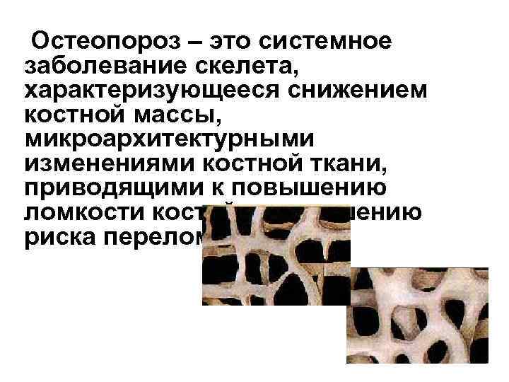 Остеопороз – это системное заболевание скелета, характеризующееся снижением костной массы, микроархитектурными изменениями костной ткани,