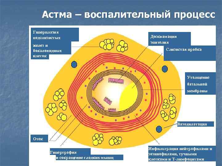 Астма – воспалительный процесс Гиперплазия подслизистых желез и бокаловидных клеток Десквамация эпителия Слизистая пробка